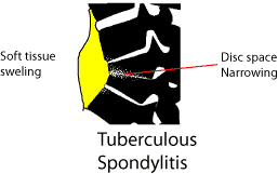 Thoracic spine in tuberculosis, showing disc narrowing and abscess