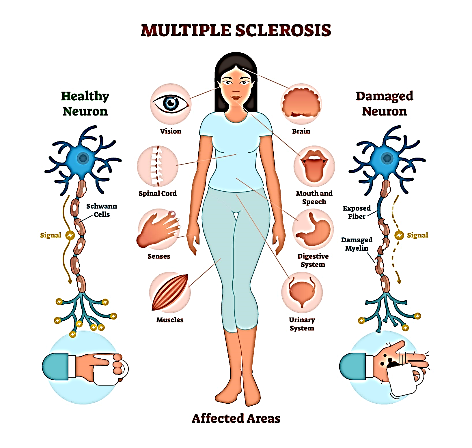 Multiple-Sclerosis-Infographic